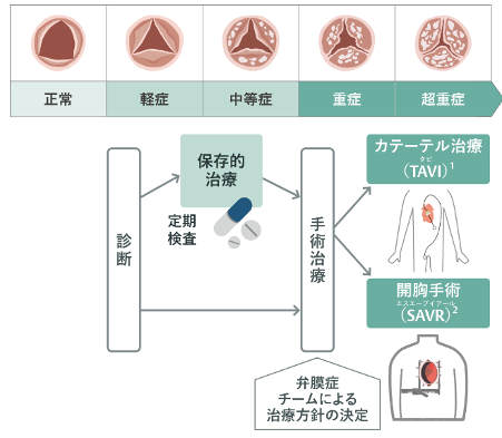 大動脈弁狭窄症に対するカテーテル手術について｜地域医療支援