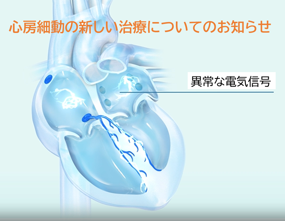 心房細動の新しい治療法の導入について
